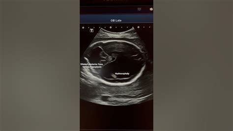 Multiple Fetal Anomalies Ultrasounddandy Walker Hydrocephalyarpkd