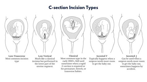 Code Stroke Home Delivery Types Of Cesarean Section Very Nice Haze Perceive
