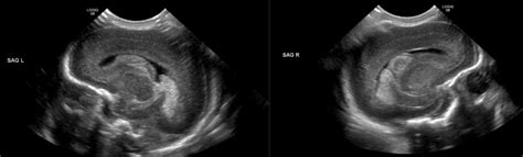 Cranial Ultrasound Uams Department Of Radiology