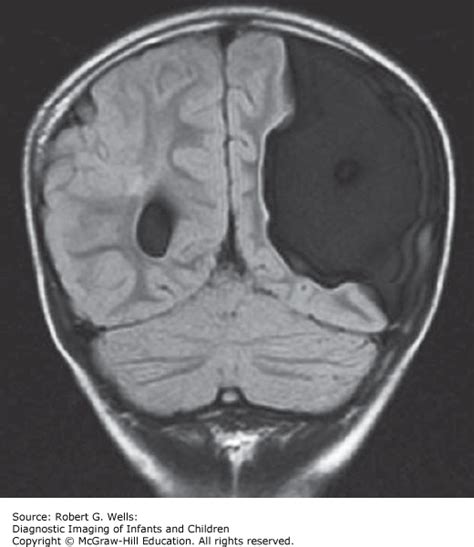 Congenital Abnormalities Of The Brain Obgyn Key