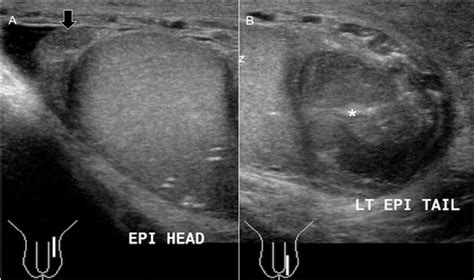 Testicular Ultrasound Epididymis