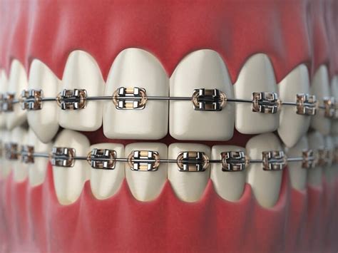Straight Talk About Braces For Adults Sunbury Dental House