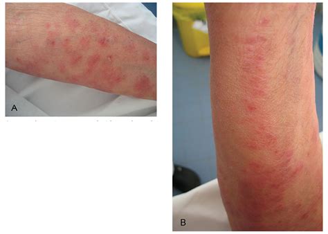 Atypical Erythema As A Clinical Presentation Of Tinea Incognito