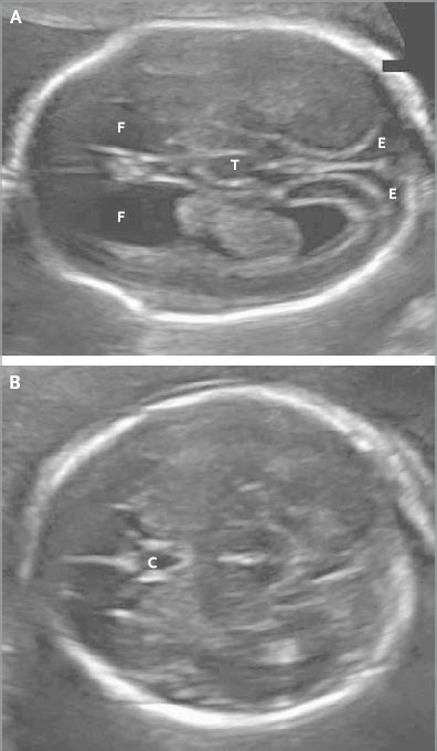 Fetal Ultrasonography At 19 Weeks Of Gestation In An Ultrasonographic