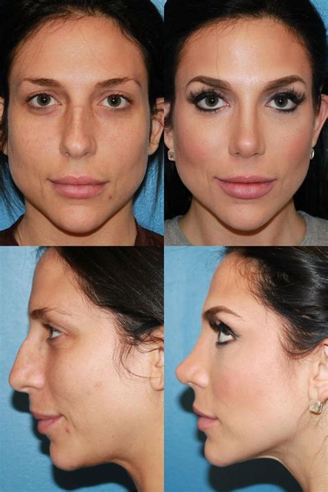 Rhinoplasty Before And After Photos Sandiego Nosejob Kylie Jenner