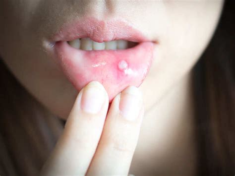 What you are getting from me is the instructional manual. How to get rid of mouth ulcers home remedies, IAMMRFOSTER.COM