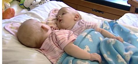 She Gave Birth To What She Were Normal Twins Then Doctors Spot Something Unbelievably Rare