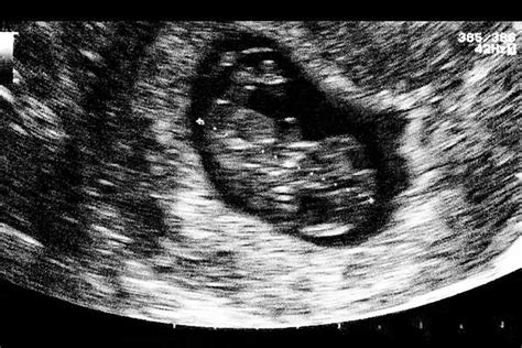 Beberapa hari lepas isteri ada mengajak untuk ke klinik ultrasound untuk membuat scan baby. 7th Week Pregnancy: Symptoms, Baby Development, Tips And ...