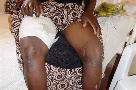 Man Pours Hot Water On Wifes Private Parts Without