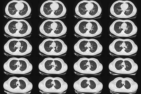 Signs Of Lung Cancer On Ct Scan The Link Between Lung Cancer And