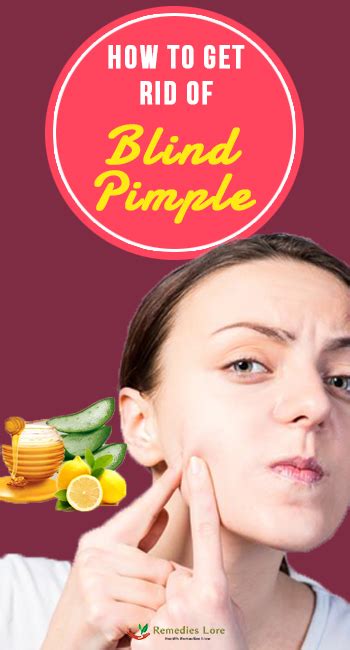 How To Get Rid Of Blind Pimple Remedies Lore