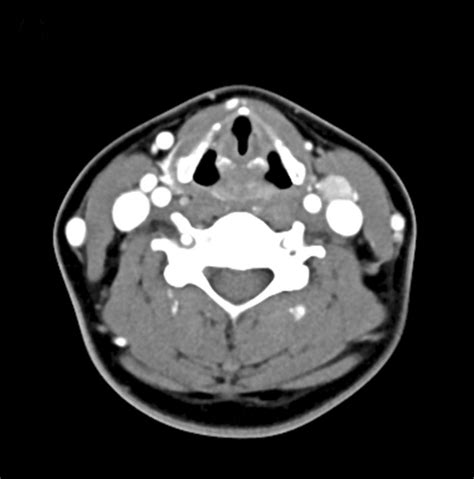 Images Of Preoperative Ct Showing Multiple Neck Lymph Node Metastases