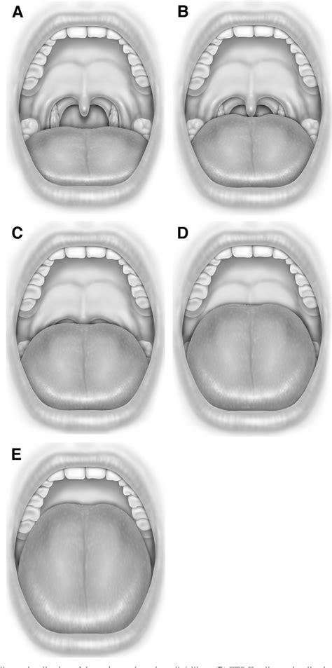 Figure 1 From Interexaminer Agreement Of Friedman Tongue Positions For