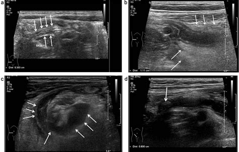 Clinical Relevance Of The Nonvisualized Appendix On Ultrasonography Of