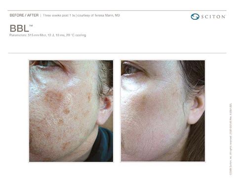 Bbl Photofacial Therapy In Beverly Hills Rebecca Fitzgerald Md