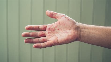 Hand Foot And Mouth Disease Symptoms Prevention And Hfmd Treatment Michigan Medicine