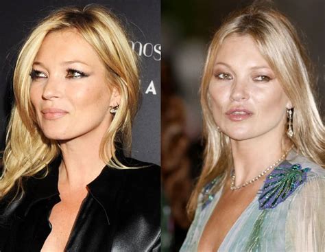Kate Moss Plastic Surgery Compare Her Photos Over The Years