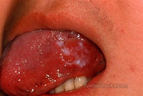 Leukoplakia Symptoms Causes Treatment Pictures Symptoms Causes