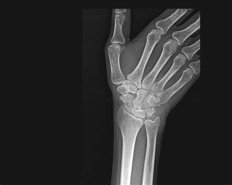 Rheumatoid Arthritis Image