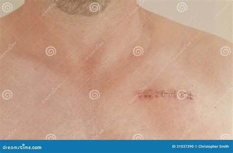 Pacemaker Scar Stock Photo Image
