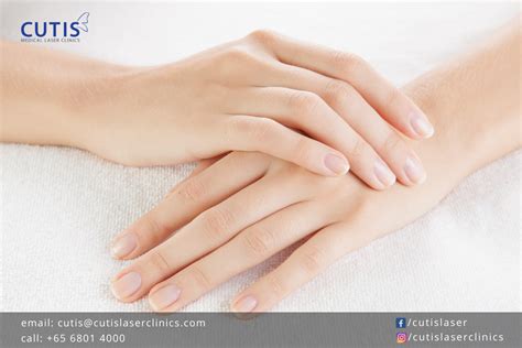 Bothered With Aging Hands Try Radiesse Treatment