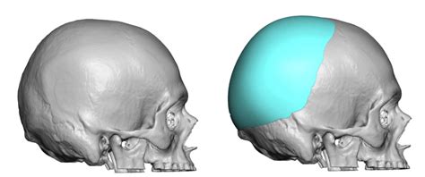 Plastic Surgery Case Study Custom Occipital Parietal Skull Implant In