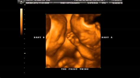 3d Ultrasound And 4d Ultrasounds In Orlando Of Twins At 25 Weeks Youtube