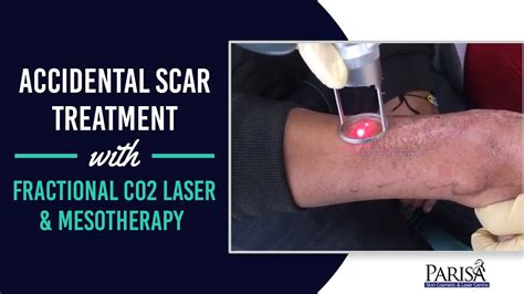 Accidental Scar Removal With Fractional Co2 Laser And Mesotherapy