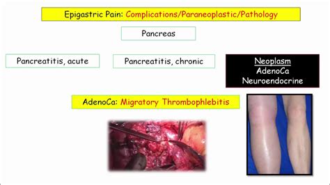 12daysinmarch Epigastric Pain And Pancreatic Disorders For Usmle Step