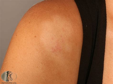Pityriasis Alba Photo Gallery Dr Dilshaad Asmal Dermatologist Cape Town