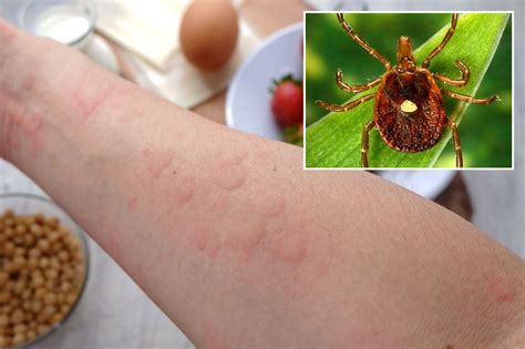 Mysterious Illness Triggered By Tick Bite Could Affect Thousands — But