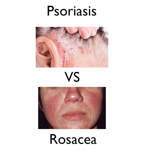 Psoriasis Vs Rosacea Do I Have Psoriasis Or Rosacea Discover The Truth