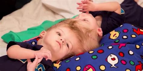 Conjoined Twins Finally Separated After 16 Hour Surgery