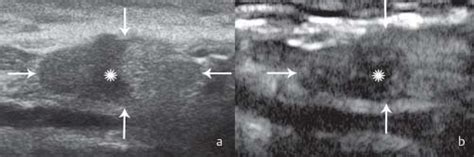 A Inguinal Lymph Node Arrows With Focal Cortical Thickening And