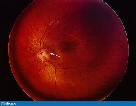 Incidental Fundus Finding In A Child With Cataract