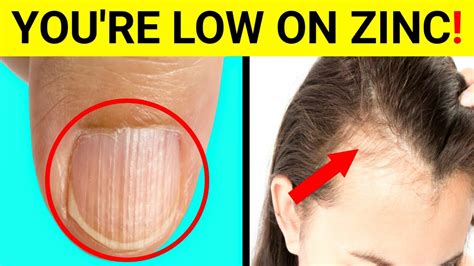 Zinc Deficiency 9 Signs And Symptoms Of Zinc Deficiency Zinc