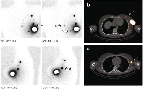 Lymphoscintigraphy And Sentinel Node Localization In Breast Cancer