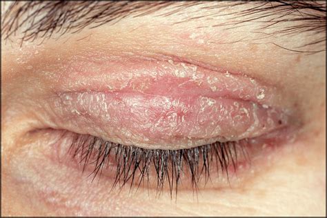 7 Causes And Effective Home Remedies To Get Rid Of Eyelid Rashes En