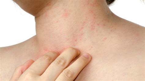 Dermatite Atopica Significato Nei Bambini Cause E Rimedi