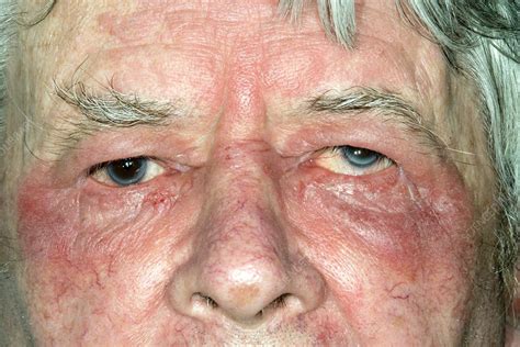 Eczema Around The Eye Stock Image C0230703 Science Photo Library