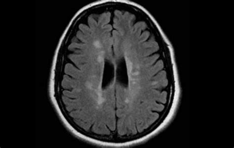Ms Brain Lesions Pictures And Prognosis