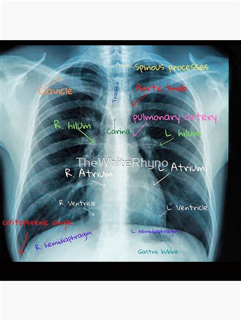 Chest X Ray With Labels Poster For Sale By Thewhiterhyno Redbubble