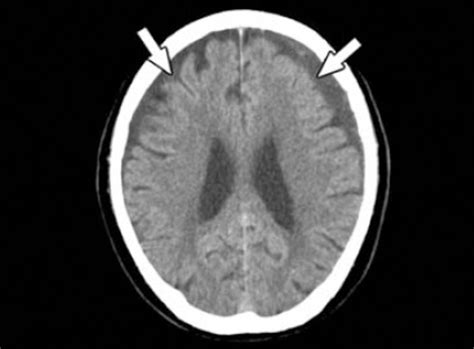 Contralateral Acute Subdural Hematoma Occurring After Evacuation Of