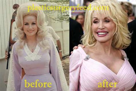 Dolly Parton Plastic Surgery Plastic Surgery Feed