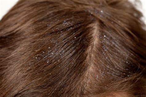 26 Easy DIY Home Remedies to Get Rid Of Dandruff Fast | hubpages