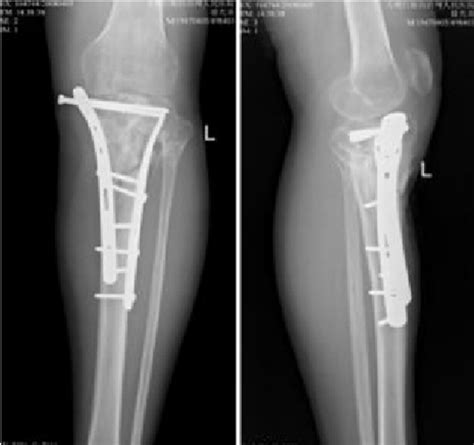 Open Reduction Internal Fixation Of Left Tibial Plateau And Shaft Fracture My Xxx Hot Girl