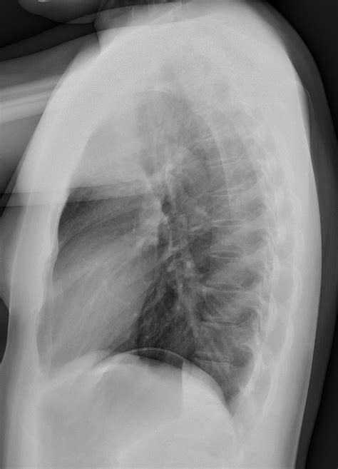 Booklet Pneumonia Chest X Ray Normal Vs Abnormal