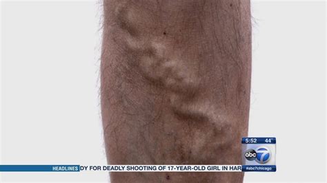 The New Face Of Varicose Veins Abc7 Chicago