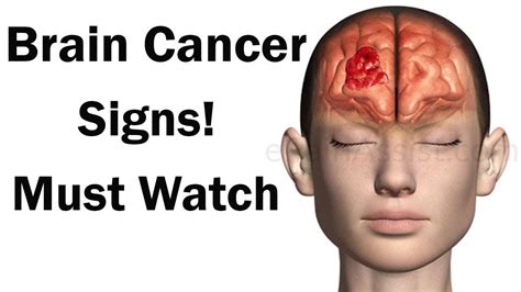 Brain Cancer Signs Brain Tumor Causes Us Health Tv Youtube