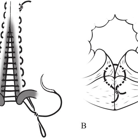 Schematics Of The Suture Technique The Vaginal Roof Was Closed With